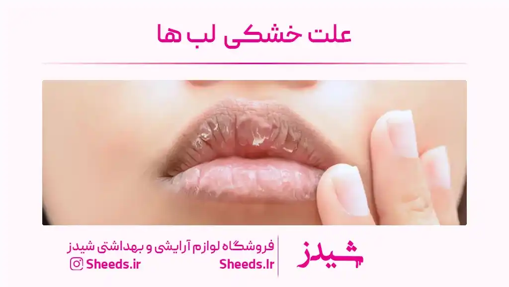 خشکی لب